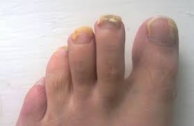 Toenail Fungus – All You Need To Know