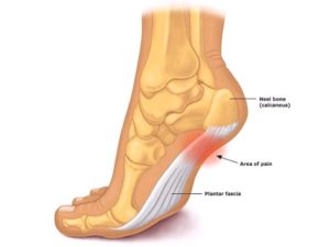 Plantar Fasciitis – All You Need To Know